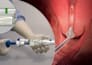 do 3d medical device animation 3d cgi animation 3d medical explainer animation